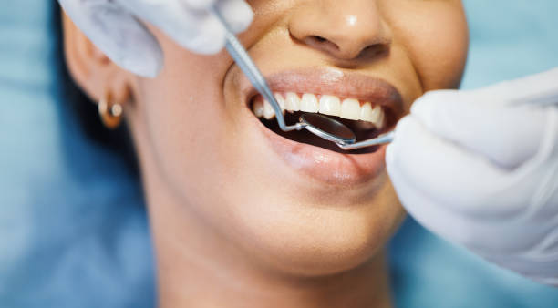 Best Knocked-Out Tooth (Avulsed Tooth) Treatment in Kings Point, NY
